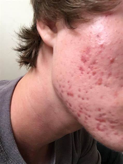 I attempted a couple of online entertainment hacks for skin break out They didn't work!