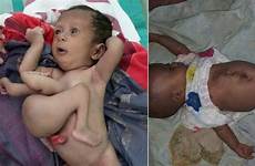 baby born twin parasitic limbs extra removed foxnews has twins parasite liver old before after her attached