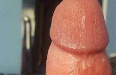 circumcised uncircumcised