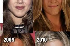 aniston jennifer nose job before plastic surgery after facelift fillers celebrity cheek her filler jobs she 1992 plus stars hasn