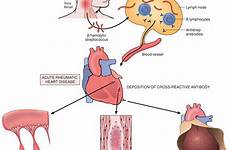 rheumatic fever disease heart rhd acute pathophysiology pathogenesis symptoms medchrome cardiac diseases children causes stepwards immune endocarditis pathology cross cause