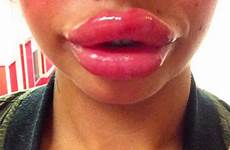 lips giant squiggly big fillers thesun pout bigger mum fad hope latest know after ever look ones didn here goodyfeed