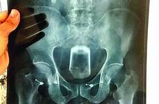 glass stuck man rectum beer into constipation his shoved chinese getting people inserts butt inserting ray why gets bottom has