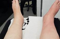 sclerosis swelling lymphedema edema swollen swell accumulation lymphatic caused symptom ankles