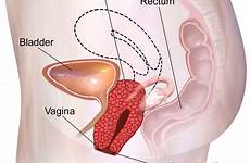 prolapse uterine pelvic organ urinary symptoms deemed physio pedia