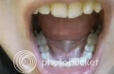 mouth whole braces before braced metal