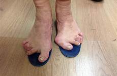 feet bunion compleet 25th