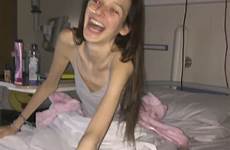 anorexic anorexia irish dublin treatment says survivor disappear wasn