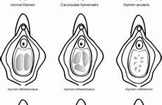 hymen sexual configurations couldn dispelling myths determining history