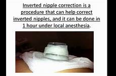 inverted nipple correction