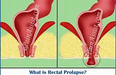 prolapse rectal anus pain protrusion anal male surgery causes pelvic treatment symptoms women men exercises floor