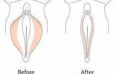labia labial hypertrophy enlarged labiaplasty treatments
