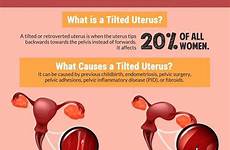 uterus retroverted tilted conceiveeasy infographic during positions fertility pelvic conceive disease