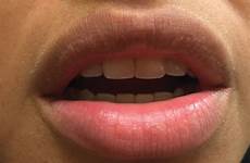 bumps mdedge lip herpes causes sore hpv painful dermatology simplex
