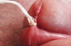 frenulum penis prepuce circumcised