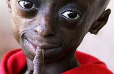 progeria child disease aging african kid rare old girl first children year syndrome africa diagnosis ontlametse cbsnews phalatse ap recap