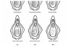 hymen types hymenal vaginal shapes opening ring wikipedia if vagina broken breaks represent areas various should variation knew never things