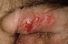 genital herpes male symptoms show gonorrhea chlamydia hsv signs