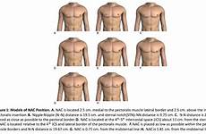 nipple areolar masculinization crowdsourcing nac abstracts