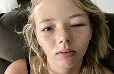 eye girl mask after teen kmart reaction left her open pain blind half