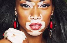 vitiligo winnie harlow pigment chantelle