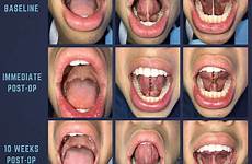 frenuloplasty do tongue tie lingual frenectomy grade functional myofunctional therapy wiley al results restrictions figure