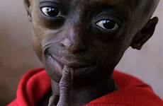 progeria kind cbs bolezni redkih podpora denis farrell hopes solace pretoria resembles fajarv
