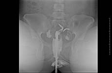 uterus didelphys tech radiology radiopaedia rad version college making back medical complete case imaging uterine