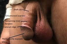 penis anatomy circumcised foreskin circumcision does perfect bdsmlr