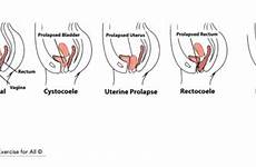 prolapse pelvic uterine dysfunction urinary