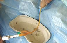 catheter urethral male catheterisation resistance gently felt pull until foreskin bladder opening reposition