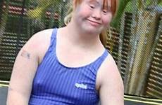 madeline stuart syndrome perceptions changing herself shed pounds control