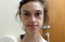 anorexia recovery anorexic hospital survivor girl weighed just mediadrumworld emelle lewis sit refused down remarkable 5st shares who calories hope