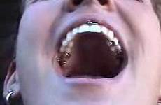 woman tooth hot her amalgams