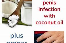 coconut balanitis penile pennis skin infections foreskin scarring hybridrastamama