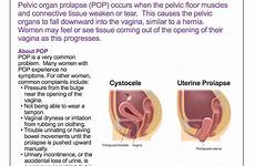 augs prolapse pelvic organ patient pop fact bladder sheets floor exercises print large