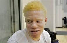albinos albino basketball star tcu fisher somali telegram ethnic any there jalen interview