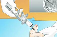 sperm testicular aspiration retrieval syringe update extraction percutaneous tese cameco testis
