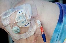 picc catheter central inserted peripherally remove