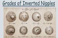 nipples inverted