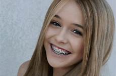braces acacia brinley orthodontic reasons still middle hairstyles brace