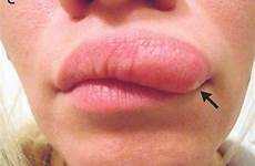 lip lump face skin worm itchy her bump upper under woman moving after swollen red when cut she russian parasite