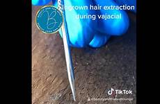 pubic ingrown mound extraction