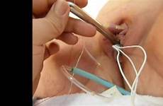 urethra sounding urethral catheter insertion electro anal shock foley thisvid tube plug
