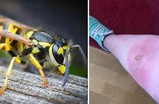 wasp sting pus filled invasion hours show lump express shocking became just