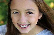 braces orthodontic orthodontist orthodontics improves appearance