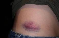bruises remedies get choose board rid therapy care