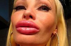 lips tits implants juvederm jenter augmentation botched utrolig digge kisses 5cc ass har