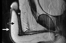 mr penis penile anatomy scrotum normal coronal imaging sagittal corpora 1a figure white arrow albuginea tunica spongiosum radiographics cavernosa weighted