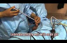 turp resectoscope urethra bipolar insertion insert video dilate cirugia sheath videos urology desde guardado